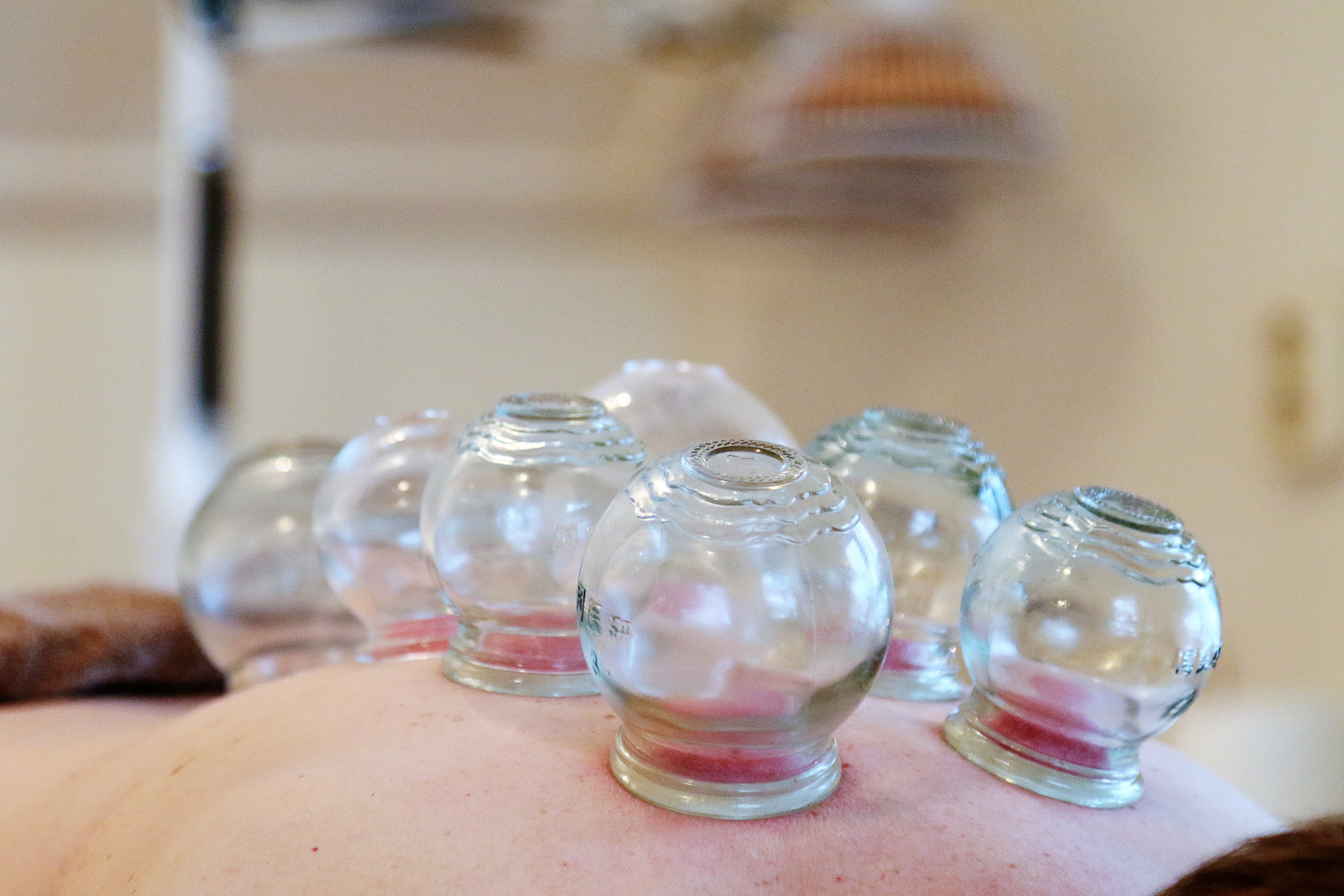 Cupping bij Praktijk An mian